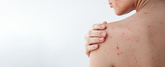 Acné après l’été : qu’est-ce que l’effet rebond et comment l’éviter ?